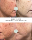 Viso LED Red Light Mask
